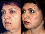 Space Lift with Short Incision Face Lift