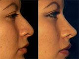 Rhinoplasty (nasal reshaping)