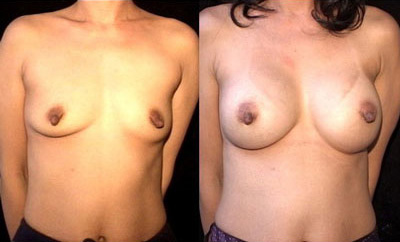 Breast Augmentation