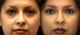 Space Lift (facial fat grafting)